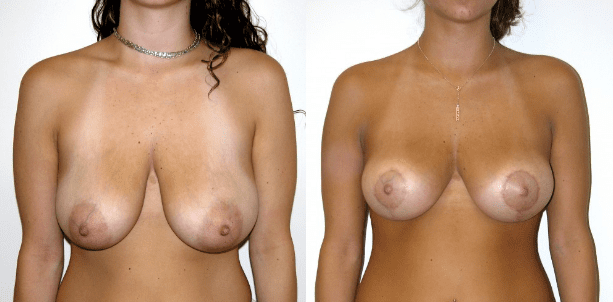 Breast Lift Before and After Photos