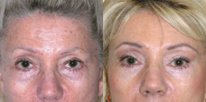 Eyelid Surgery Before and After Photos