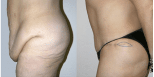 Tummy Tuck Before and After