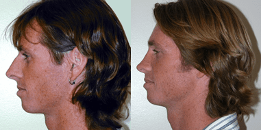 Rhinoplasty Before and After Photos