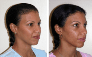 Rhinoplasty Before and After