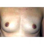Breast Augmentation 36
