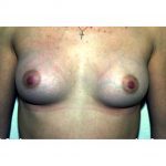 Breast Augmentation 36 After Photo - 6