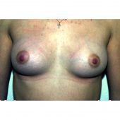 Breast Augmentation 36