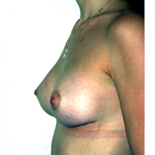 Breast Augmentation 36 After Photo