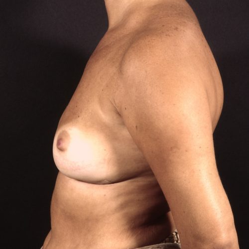 Breast Revision 1 After Photo