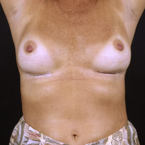 Breast Revision 1 After Photo