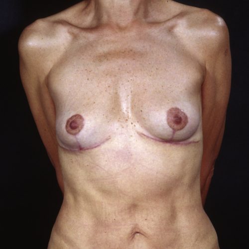 Breast Revision 2 After Photo 