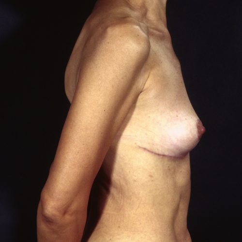 Breast Revision 2 After Photo