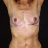 Breast Revision 2 After Photo Thumbnail