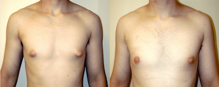 Male Breast Surgery Before and After Photos