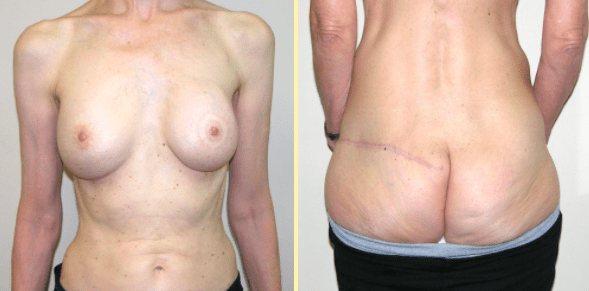 Breast Reconstruction Patient by Dr. Boyd