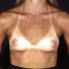 Breast Augmentation 38 Before Photo Thumbnail