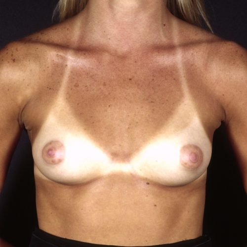 Breast Augmentation 38 Before Photo 