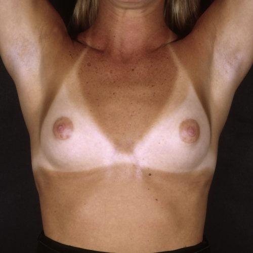Breast Augmentation 38 Before Photo