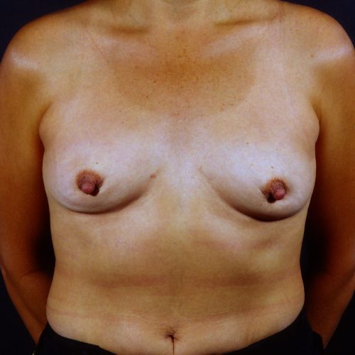 Breast Revision 5 After Photo 