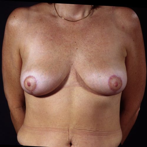 Breast Revision 3 After Photo 