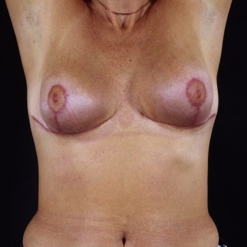 Breast Revision 3 After Photo