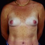 Breast Augmentation 39 Before Photo - 5