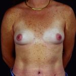 Breast Augmentation 39 Before Photo - 10