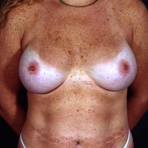 Breast Augmentation 39 After Photo 
