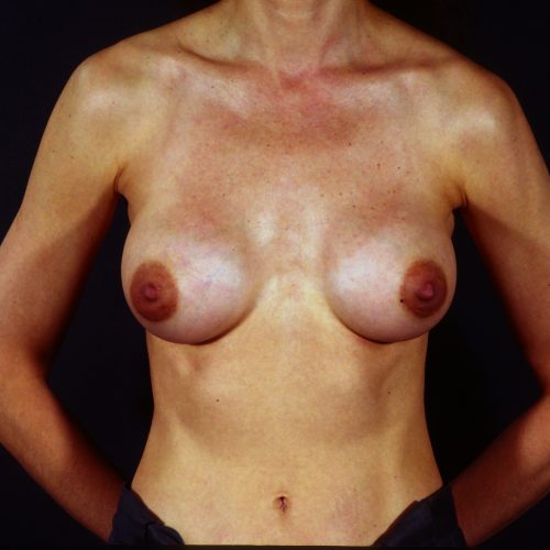Breast Revision 6 Before Photo 