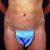 Liposuction Abdomen 1 After Photo Thumbnail