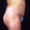 Liposuction Abdomen 1 After Photo Thumbnail