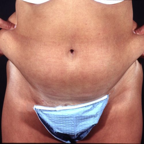 Liposuction Abdomen 1 Before Photo 