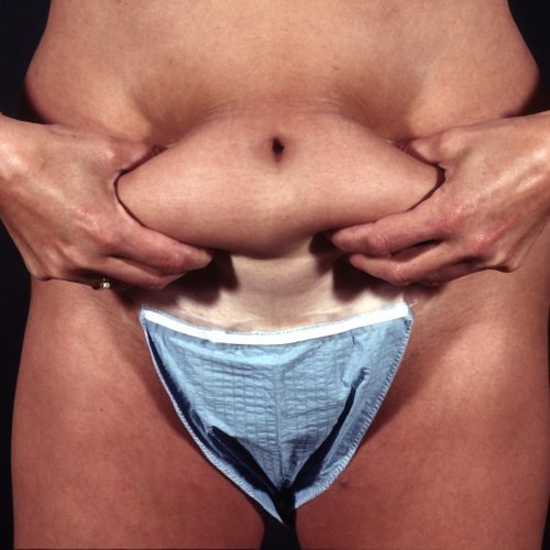 Liposuction Abdomen 1 After Photo 