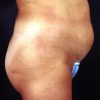 Liposuction Abdomen 1 Before Photo Thumbnail