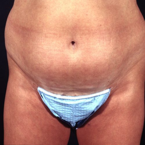 Liposuction Abdomen 1 Before Photo