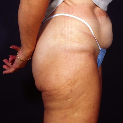 Liposuction 1x After Photo
