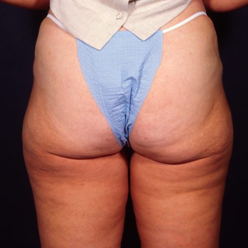 Liposuction 1x After Photo