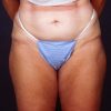 Liposuction 1x After Photo Thumbnail