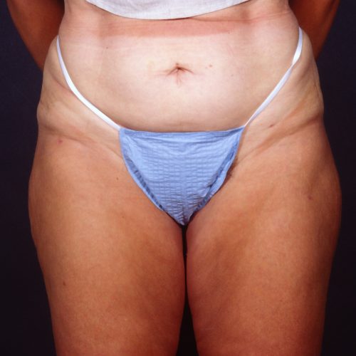 Liposuction 1x After Photo 