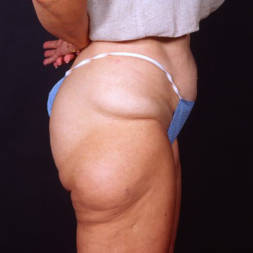 Liposuction 1x Before Photo