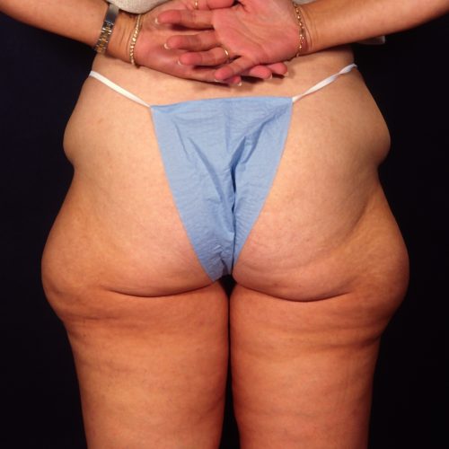 Liposuction 1x Before Photo