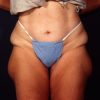 Liposuction 1x Before Photo Thumbnail