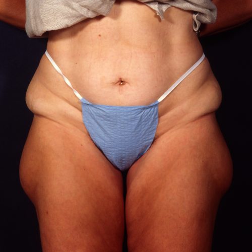 Liposuction 1x Before Photo 