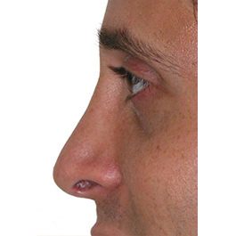 Rhinoplasty Revision 01 After Photo