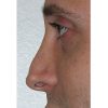 Rhinoplasty Revision 01 Before Photo Thumbnail