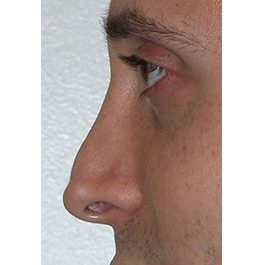 Rhinoplasty Revision 01 Before Photo