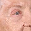 Blepharoplasty 101 After Photo Thumbnail