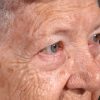 Blepharoplasty 101 Before Photo Thumbnail