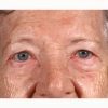 Blepharoplasty 101 Before Photo Thumbnail