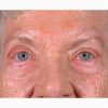 Blepharoplasty 101 After Photo Thumbnail