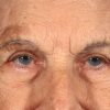 Blepharoplasty 100 After Photo Thumbnail