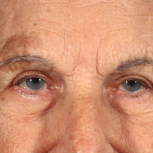 Blepharoplasty 100 After Photo