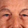 Blepharoplasty 100 Before Photo Thumbnail